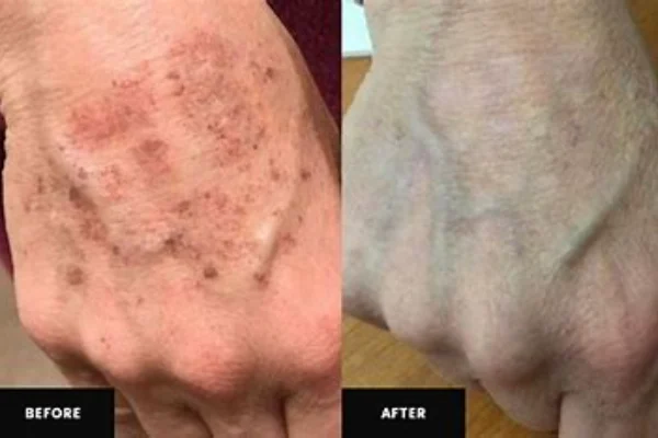 Alexander variable stone laser reduces excessive pigmentation-crylink