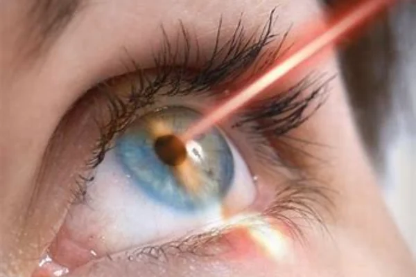 Laser Eye Surgery