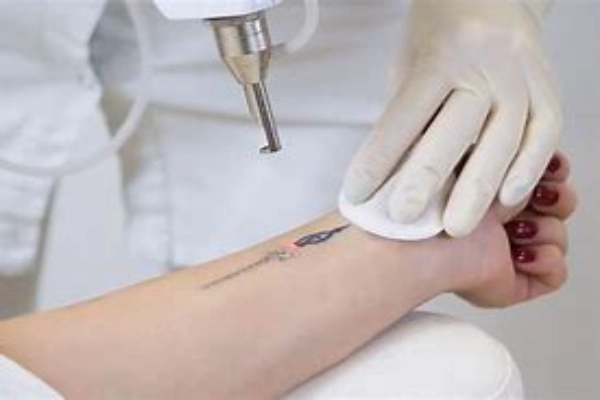 Laser Tattoo Removal