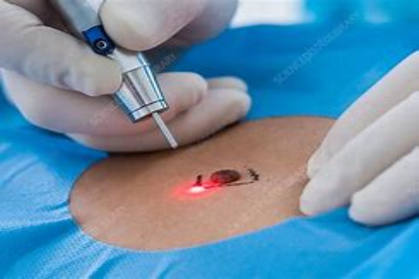 Laser removal of elderly nevi